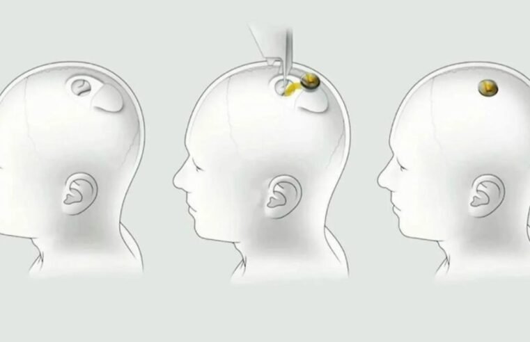 Implantes cerebrais serão baratos e acontecerão em 10 minutos