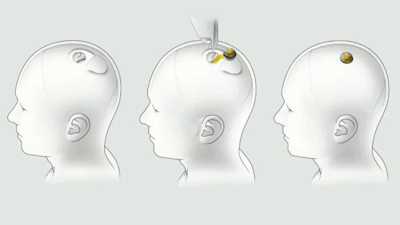 Implantes cerebrais serão baratos e acontecerão em 10 minutos